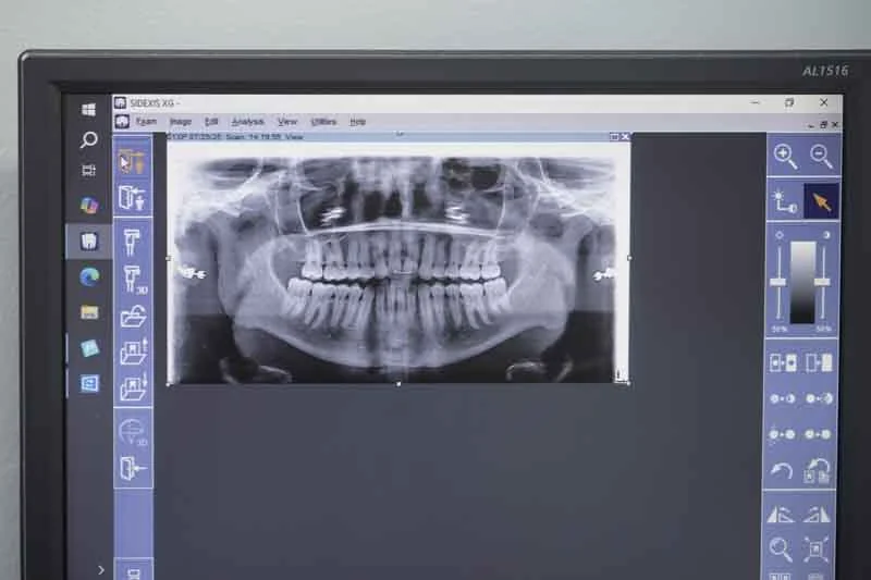digital X-rays used at Big River Dental